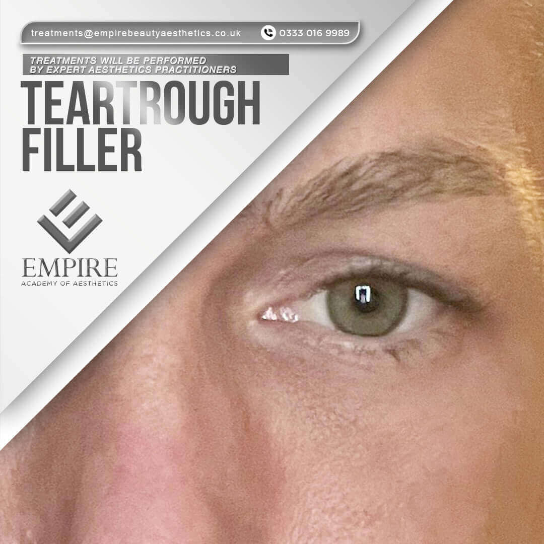 Teartrough Filler treatment as a model in our Chester clinic