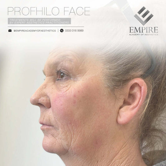 Profhilo course for the face area