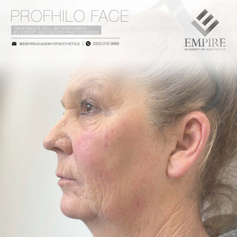 Profhilo course for the face area