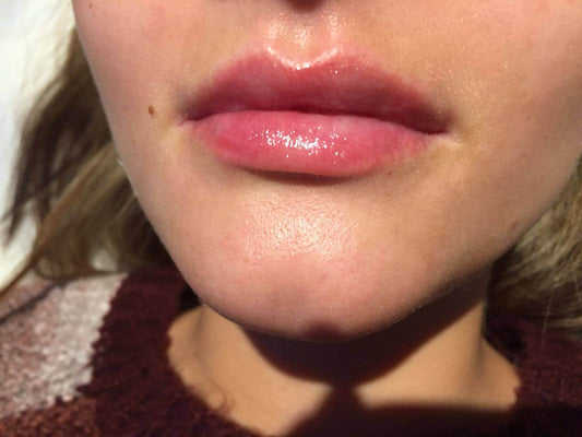 Perfecting Pouts: Mastering The Lip Augmentation Course